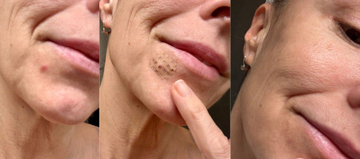 Crosslinq application on an acne spot