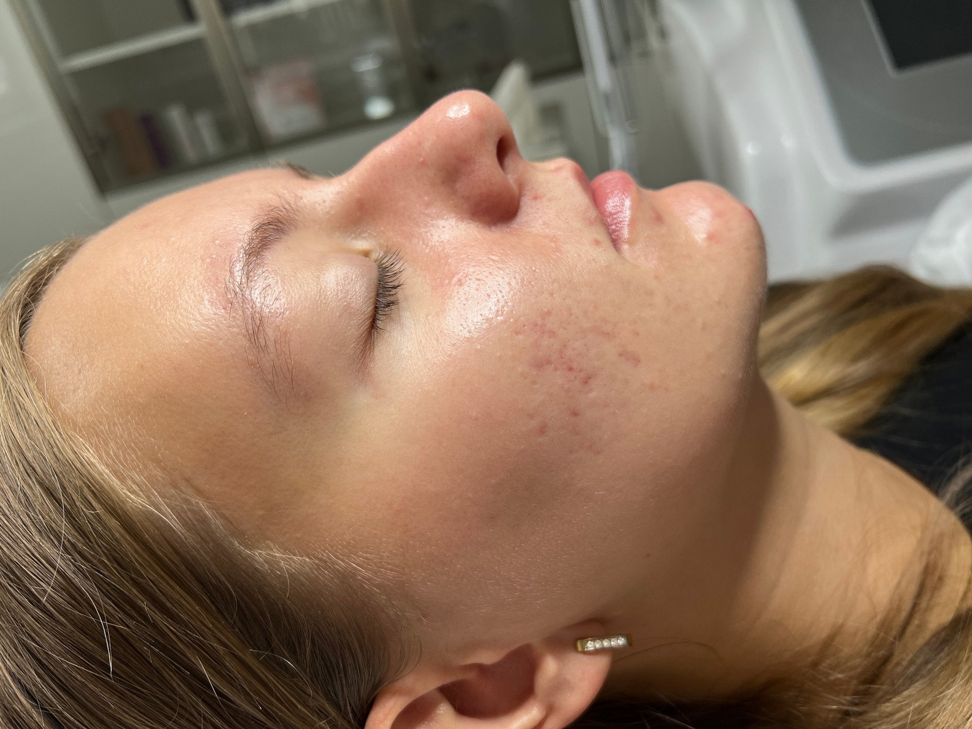 Close-up of facial skin after applying CrossLinq skin patches