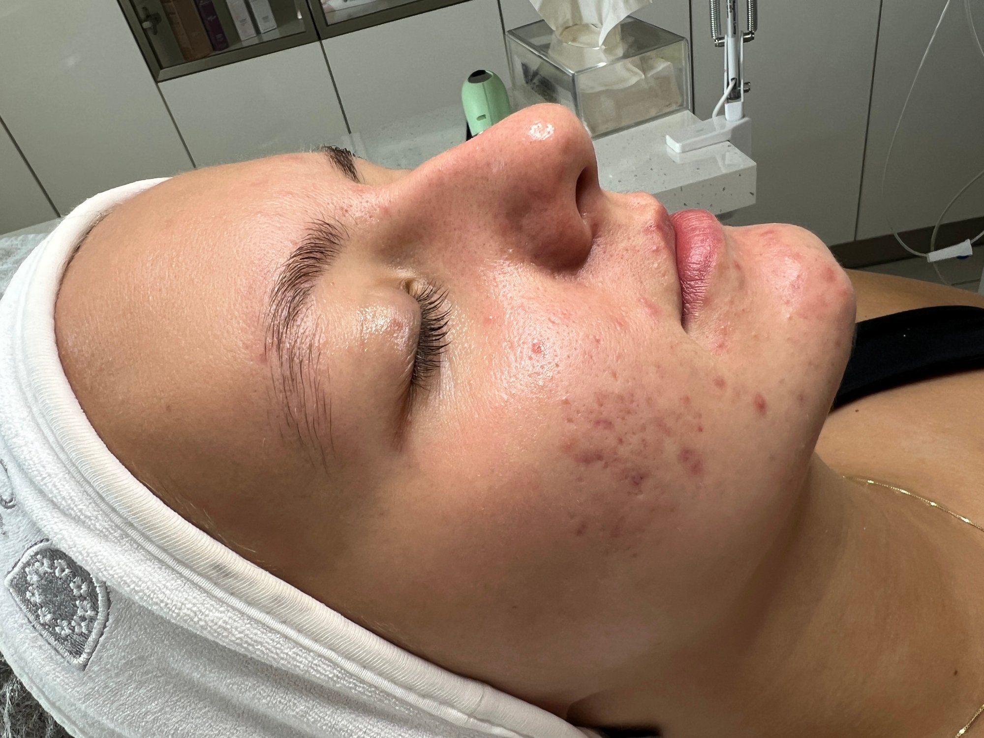 Close-up of facial skin before applying CrossLinq skin patches