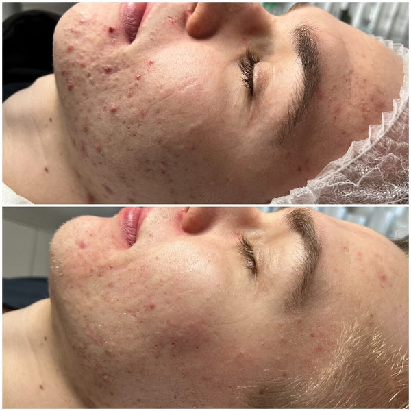 before and after using crosslinq crosspatches to help with acne on a face